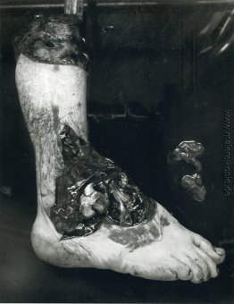 Untitled (amputierter Fuß)