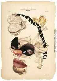 Myomen der Gebärmutter